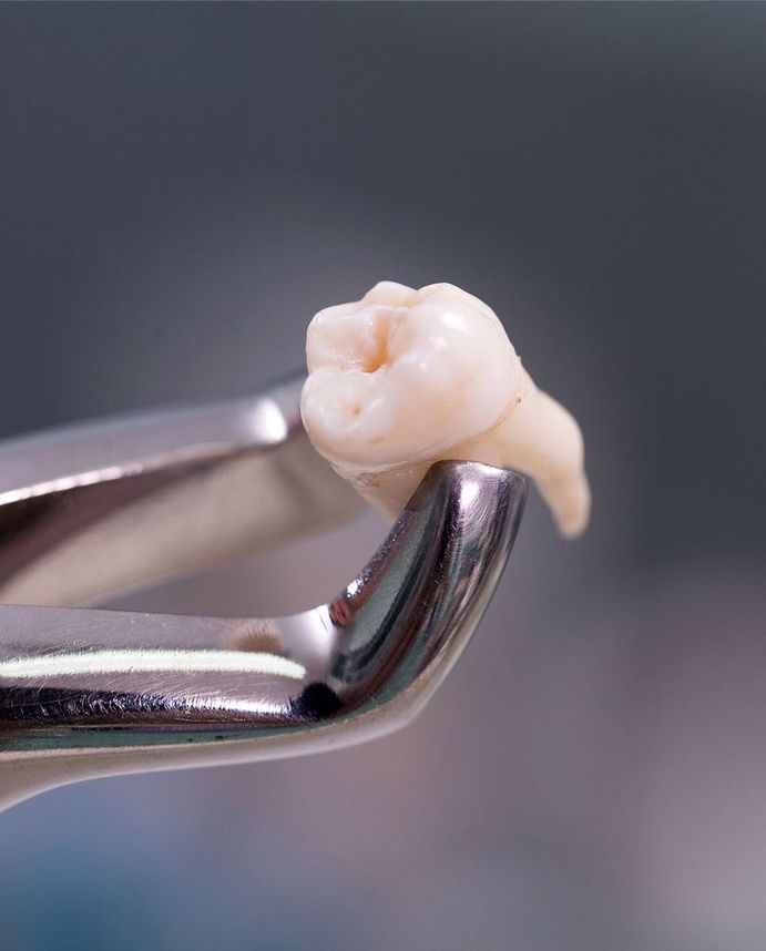 Zahn wird mit einer Zange nach der Extraktion gehalten