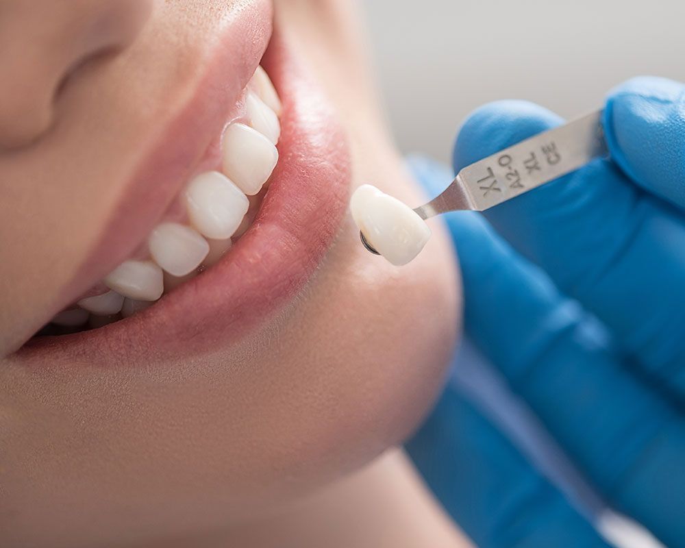 Zahnarzt hält ein Veneer zur Farb- und Formanpassung vor ein natürliches Gebiss