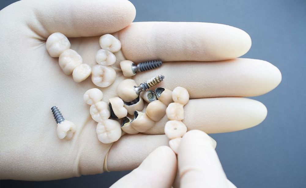 Mehrere Zahnimplantate mit Schraubenverankerung liegen auf einer behandschuhten Hand