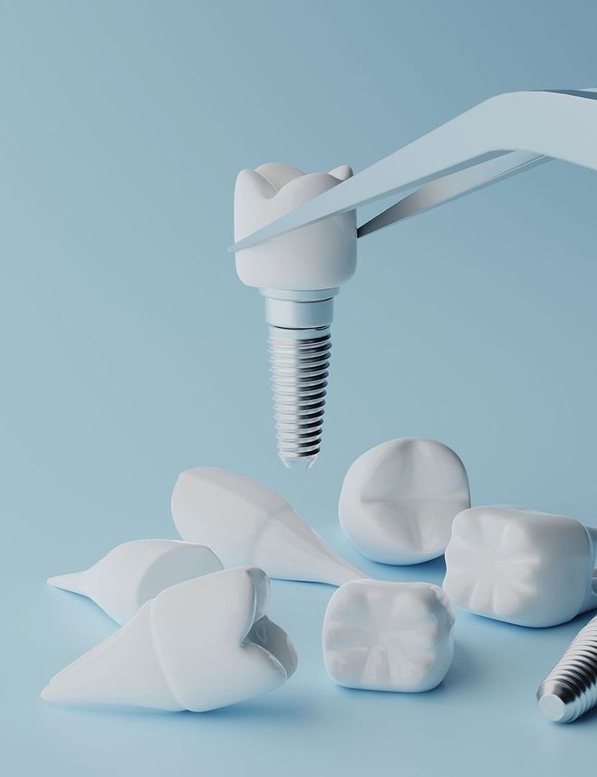 Zahnimplantat mit Krone in Pinzette auf blauem Hintergrund