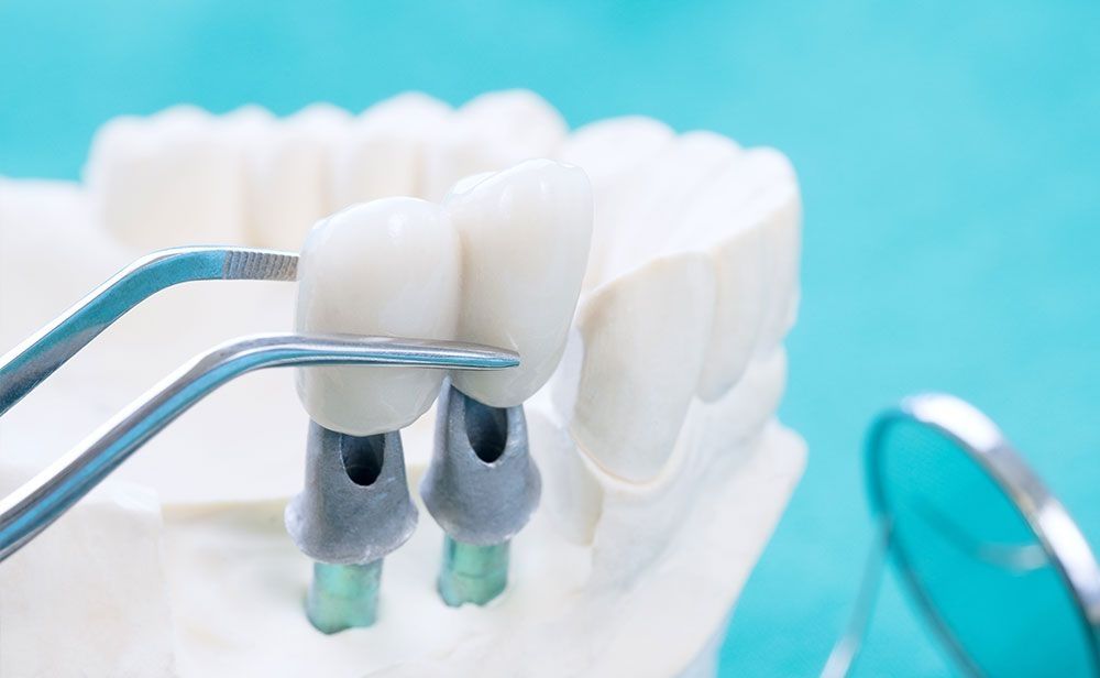 Einsetzen einer Zahnbrücke auf Implantate mit Pinzette