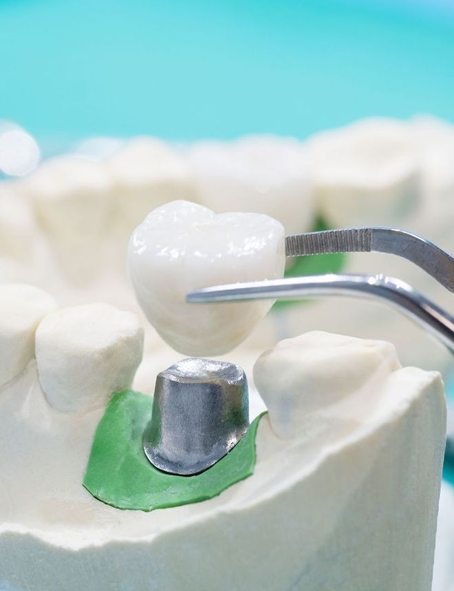 Einsetzen einer Zahnkrone auf ein vorbereitetes Implantatmodell mit Pinzette