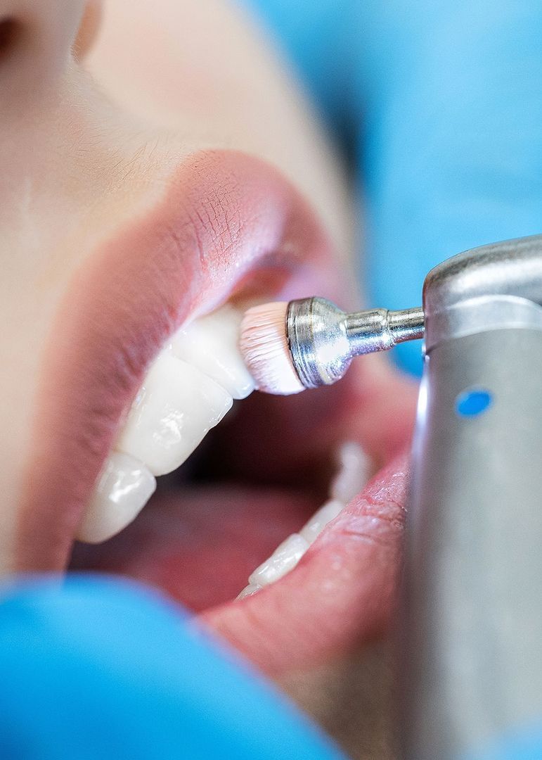 Großaufnahme einer Polierbürste bei der Zahnreinigung